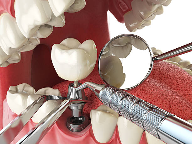 Best Emergency Root Canal Treatment in Perry, KS